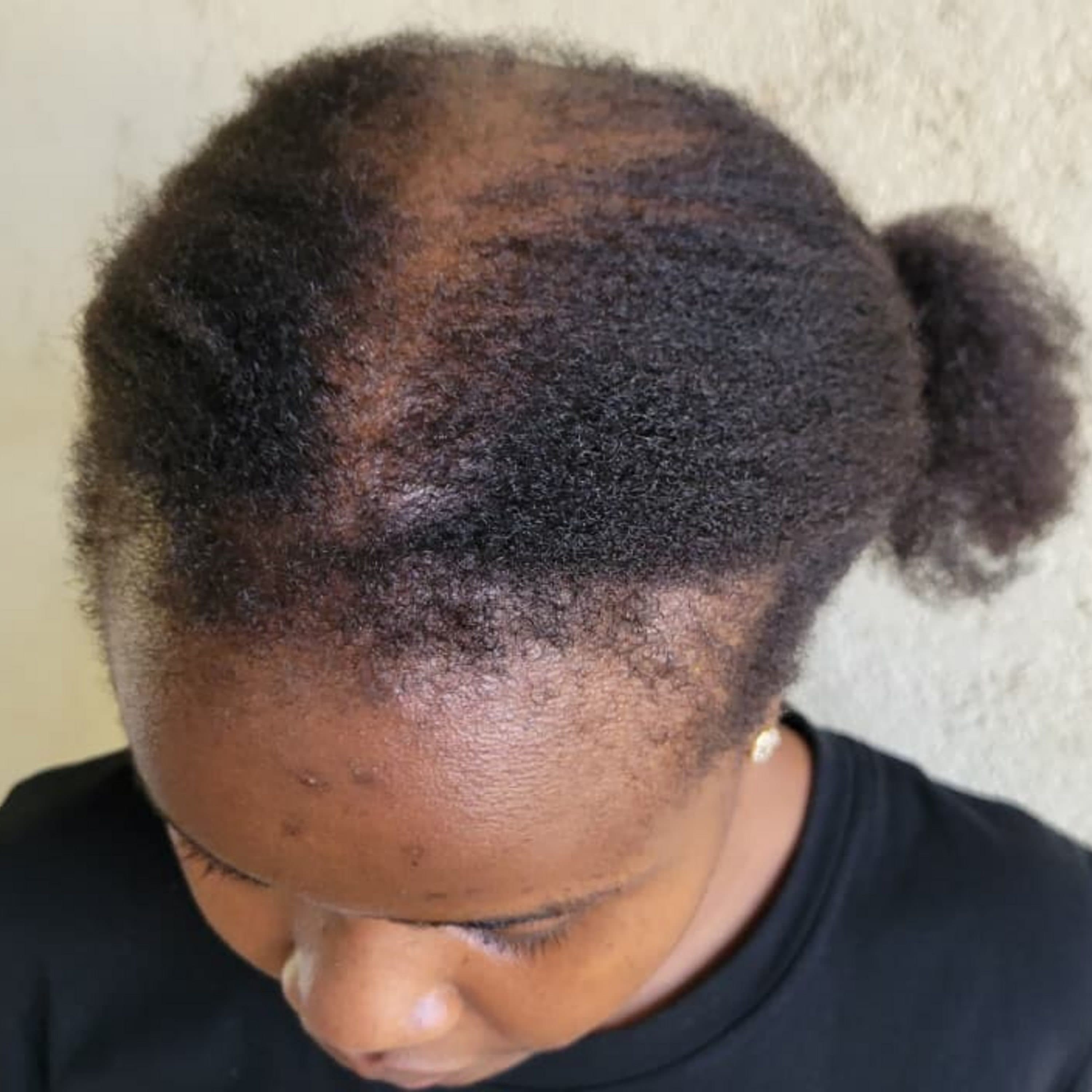 "I'm 23 and losing my hair"