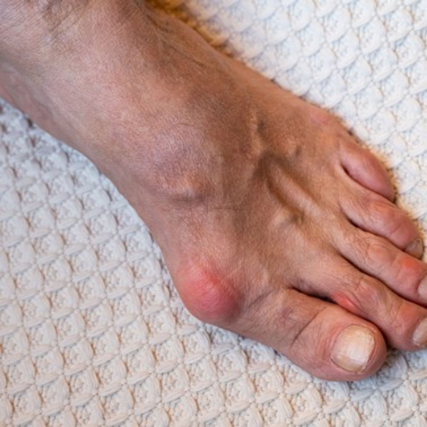 EKU2022.1: Gout