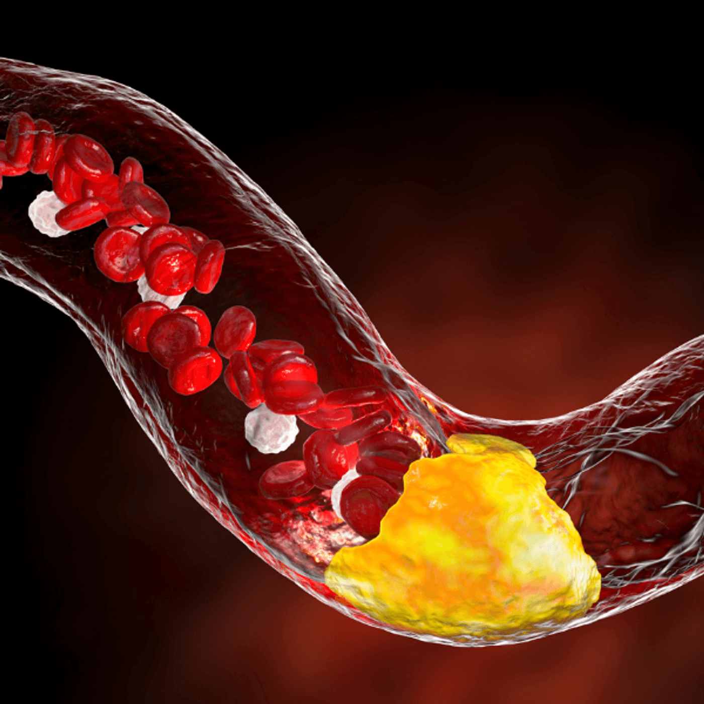 Lipids and cardiovascular disease