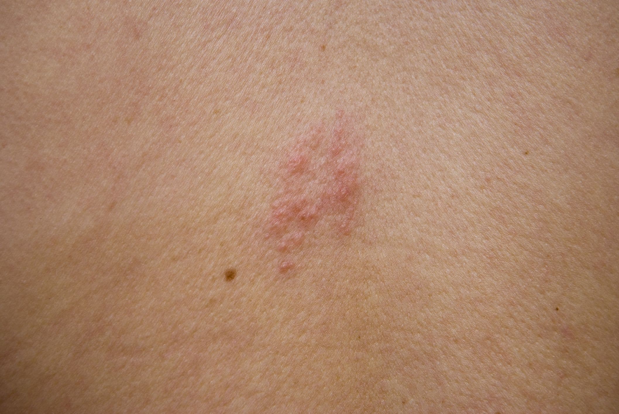 Shingles Podcast