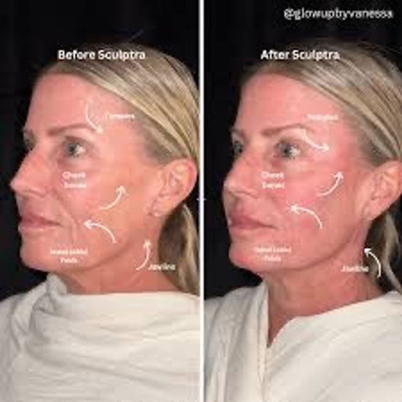750: Facial Balancing & Collagen Stimulators: Build Beauty That Lasts