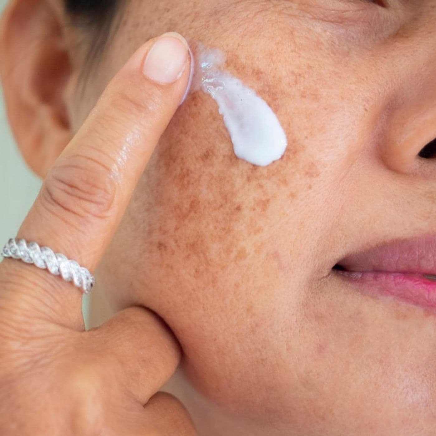 762: Hyperpigmentation: Best Practices for Best Skin