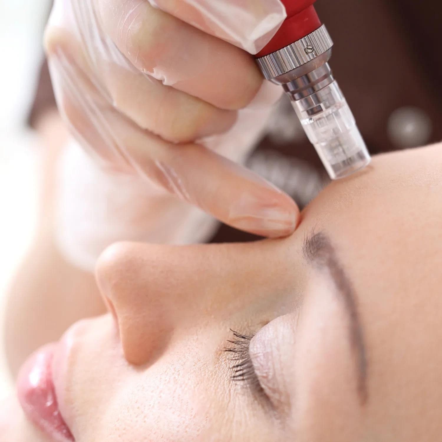 767: Microneedling: Moving the Needle in Skin Rejuvenation and Collagen Reproduction 